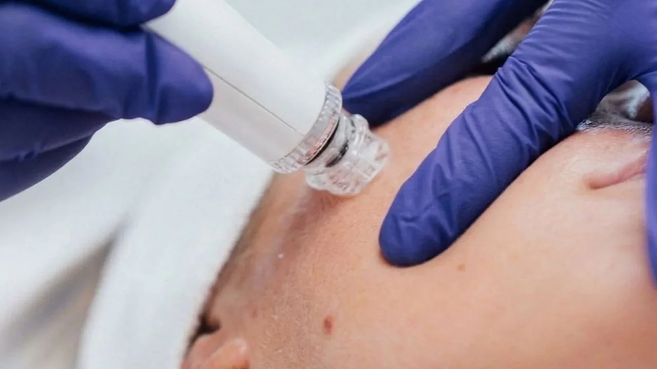 Limpieza Hidrafacial